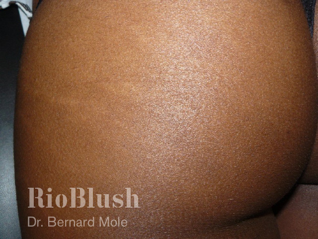 Stretch marks after